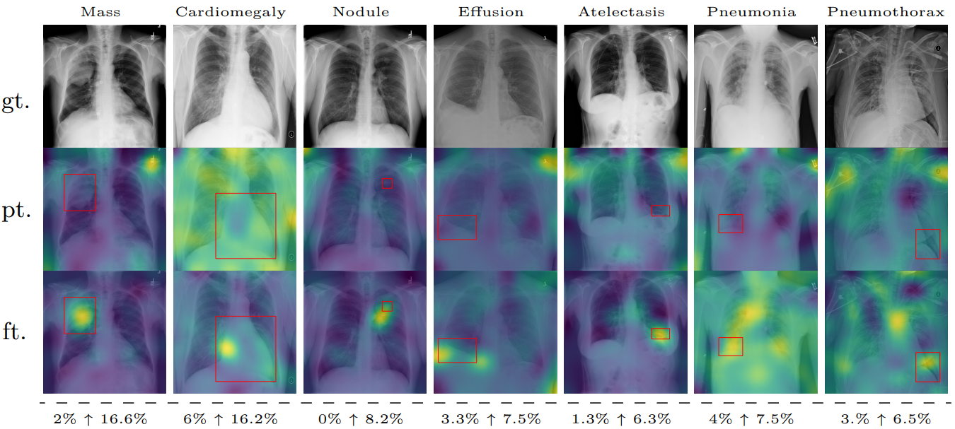 Visualization of typicality on frontal view X-ray showing improve localization after finetuning